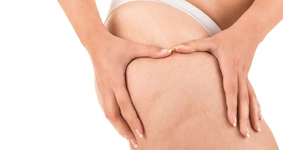 Remedios contra la celulitis: ¿Qué funciona?