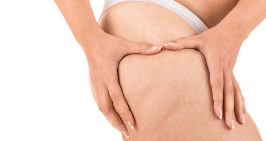 Remedios contra la celulitis: ¿Qué funciona?